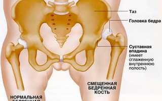 Смещение тазобедренного сустава: симптомы и лечение у взрослых
