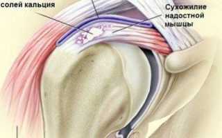 Какого лечения требует отложение солей в плечевом суставе