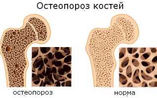 Остеопороз — симптомы и лечение в домашних условиях. Диагностика и профилактика остеопороза у женщин