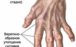 Узелки Гебердена и Бушара: симптомы, диагностика и лечение